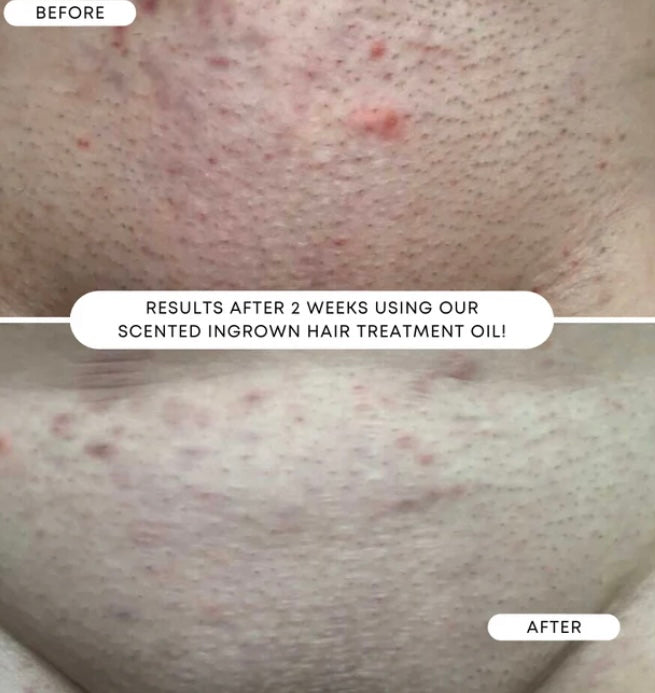 Ingrown Hair & Pre-Post Wax Oil- SWEET ESCAPE