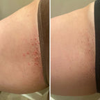 Ingrown Hair Exfoliating Body Scrub- Watermelon Sugar