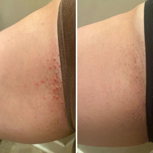 Ingrown Hair Exfoliating Body Scrub- Watermelon Sugar